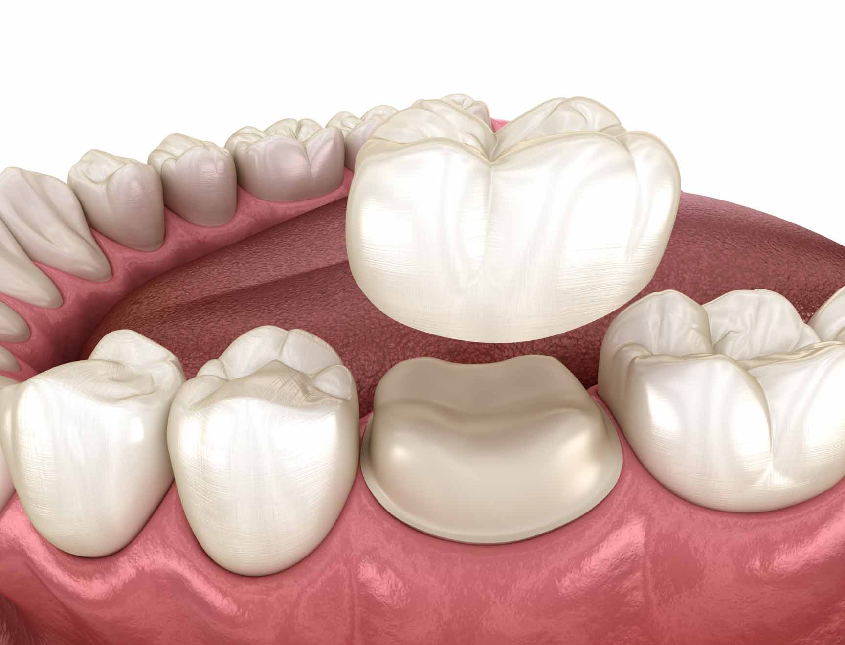 Ceramic Crowns - Princetonsmile.com